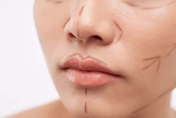 Yüz Germe – Face Lift